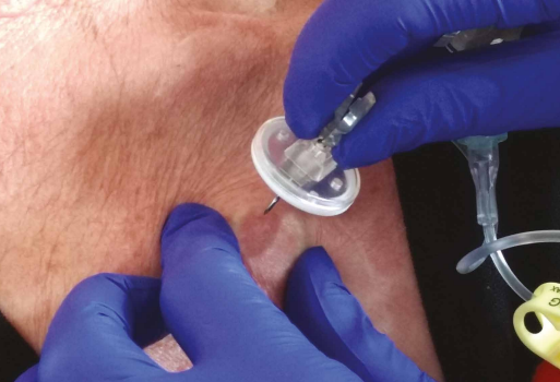 Placement Aiguille de Huber dans un PAC
